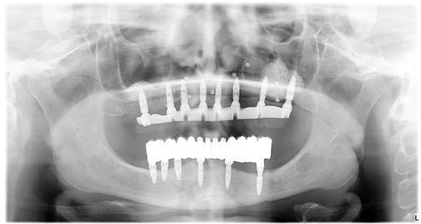 Implantes Dentales All on 6