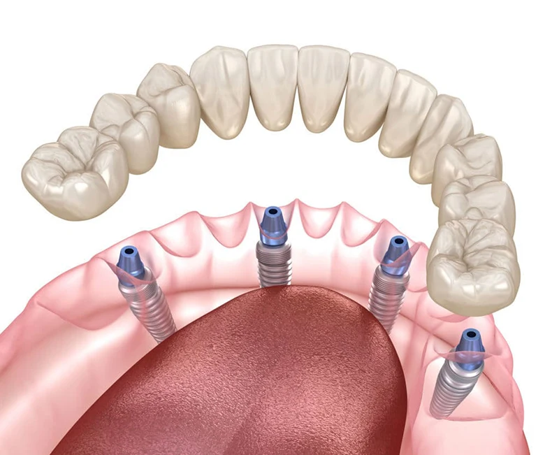 Implantes en un día