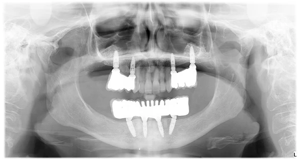 Implantes Dentales All on 4