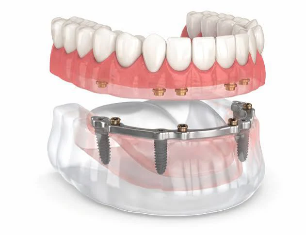 Sobredentadura sobre 4 implantes